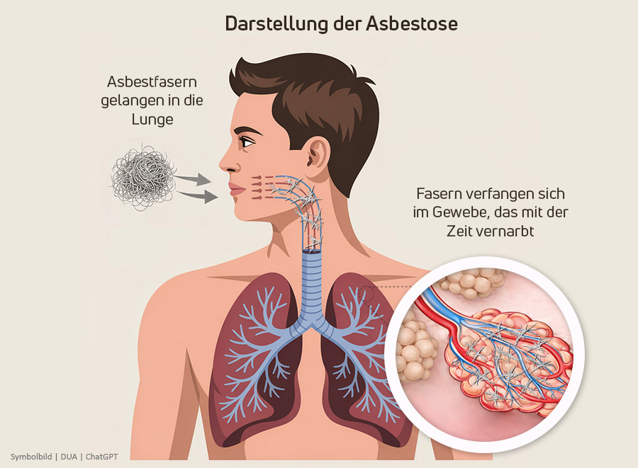 Schaugrafik das Asbestose erklärt